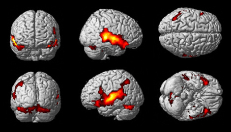 Neuroimágenes